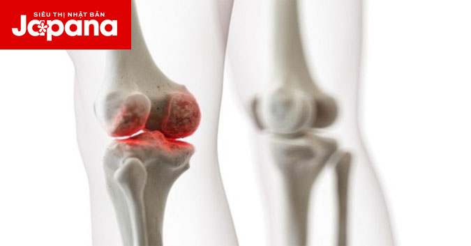 Phòng ngừa thoái hóa khớp bằng 7 cách sau đây